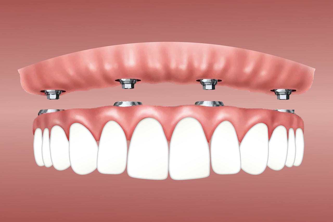 Jakie protezy zębowe wybrać: ruchome czy stałe?